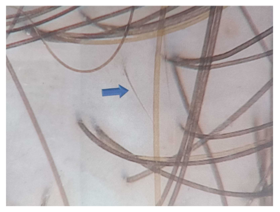 Trihhoskoopia: Revolutsiooniline meetod juuste ja peanaha tervise diagnoosimisel